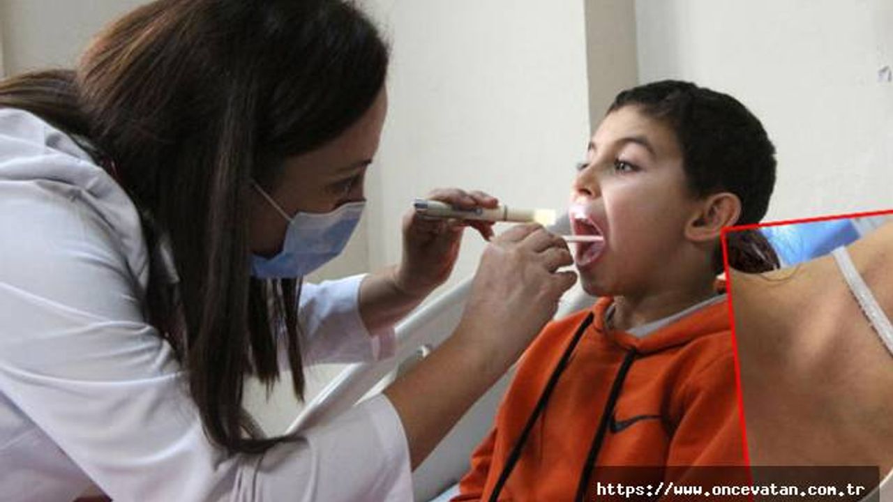 Strep A'nın neden olduğu kızıl vakaları arttı