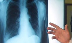 Ege Üniversitesinde borik asidin akciğer kanseri tedavisine yönelik etkisi araştırılacak