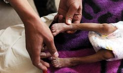 "Dünya Nadir Hastalıklar Günü" bu yıl, yılın en nadir gününde kutlanıyor
