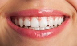 İnvisalign Nedir ve Avantajlari Nelerdir