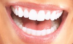Lamine Diş Kaplamalarının Bakımı: Nelere Dikkat Edilmeli?