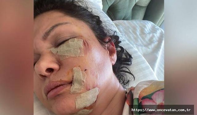 Şile'de köpek saldırısına uğrayan şarkıcı Tuğba Altıntop'un yüzüne dikiş atıldı