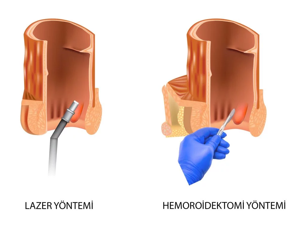 Lazer Ile Hemoroid Tedavisi Ve Geleneksel Hemoroidektomi Tedavisi Karşılaştırması